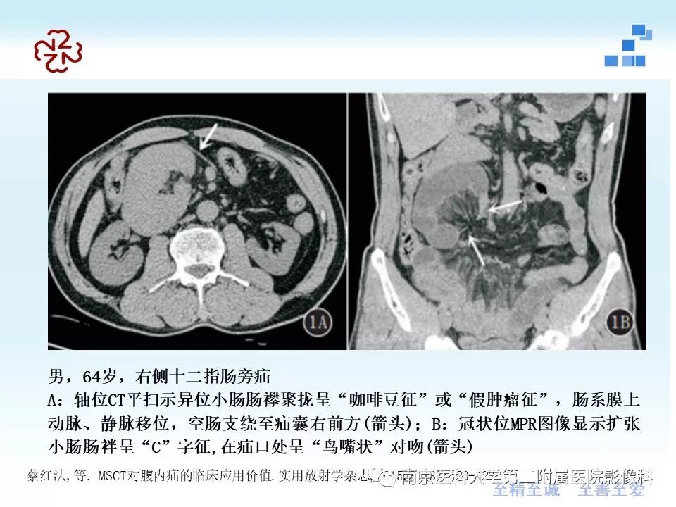 【PPT】腹内疝的CT表现