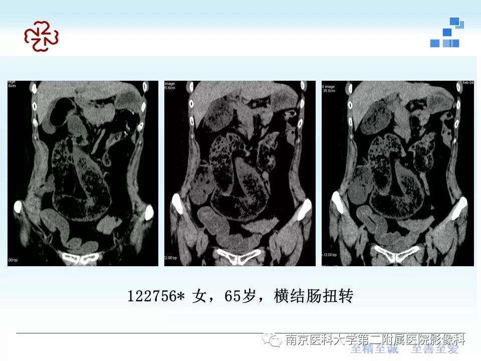【PPT】腹内疝的CT表现