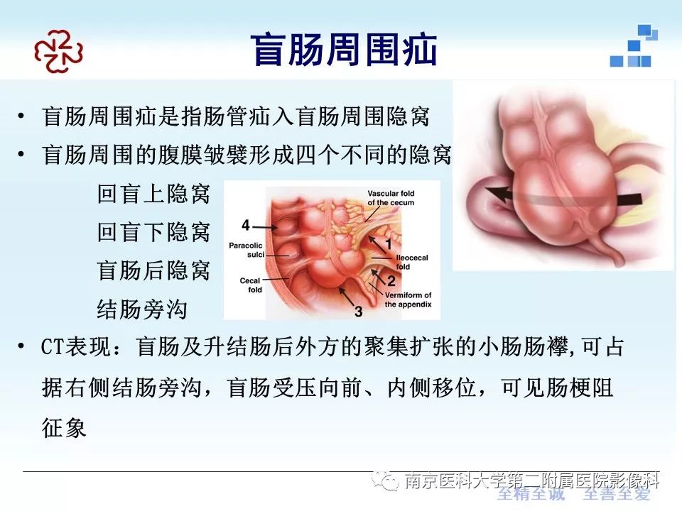 【PPT】腹内疝的CT表现