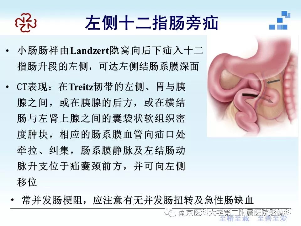 【PPT】腹内疝的CT表现