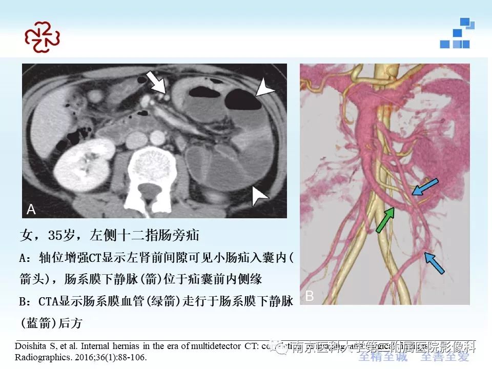 【PPT】腹内疝的CT表现