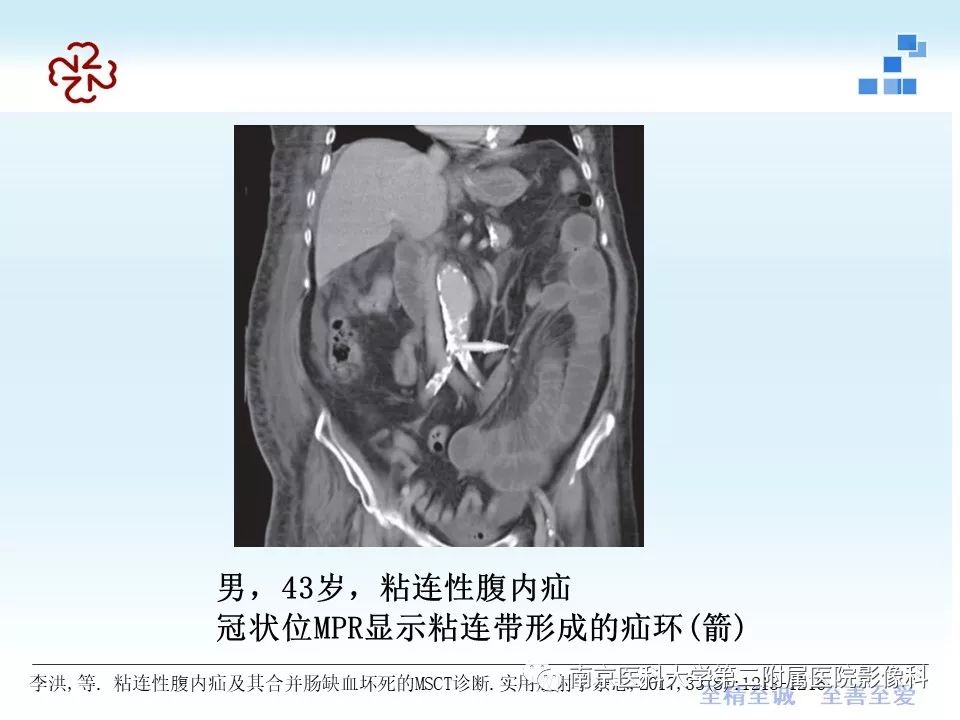 【PPT】腹内疝的CT表现