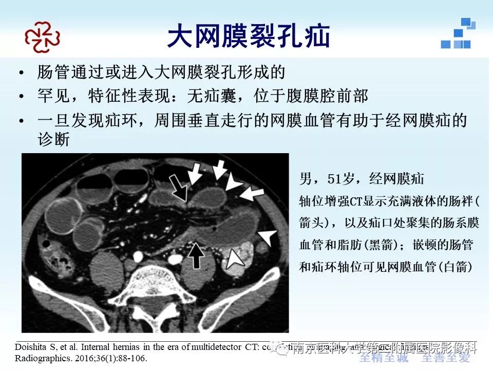 【PPT】腹内疝的CT表现