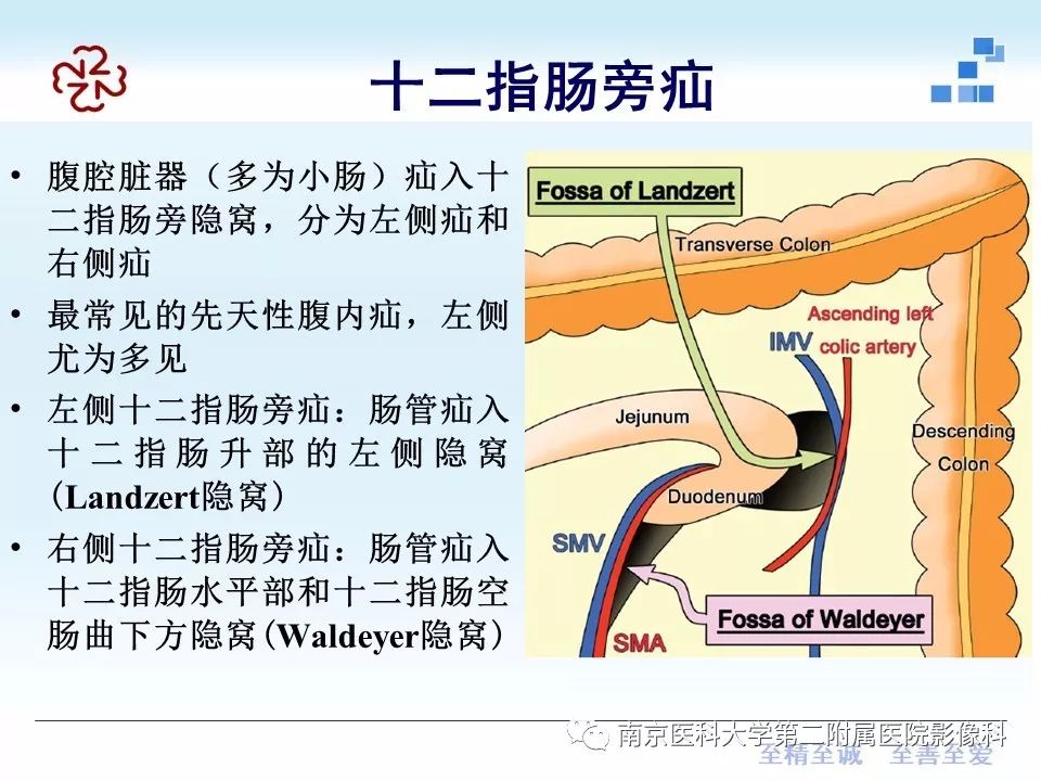 【PPT】腹内疝的CT表现