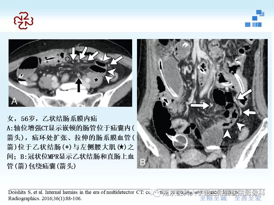【PPT】腹内疝的CT表现