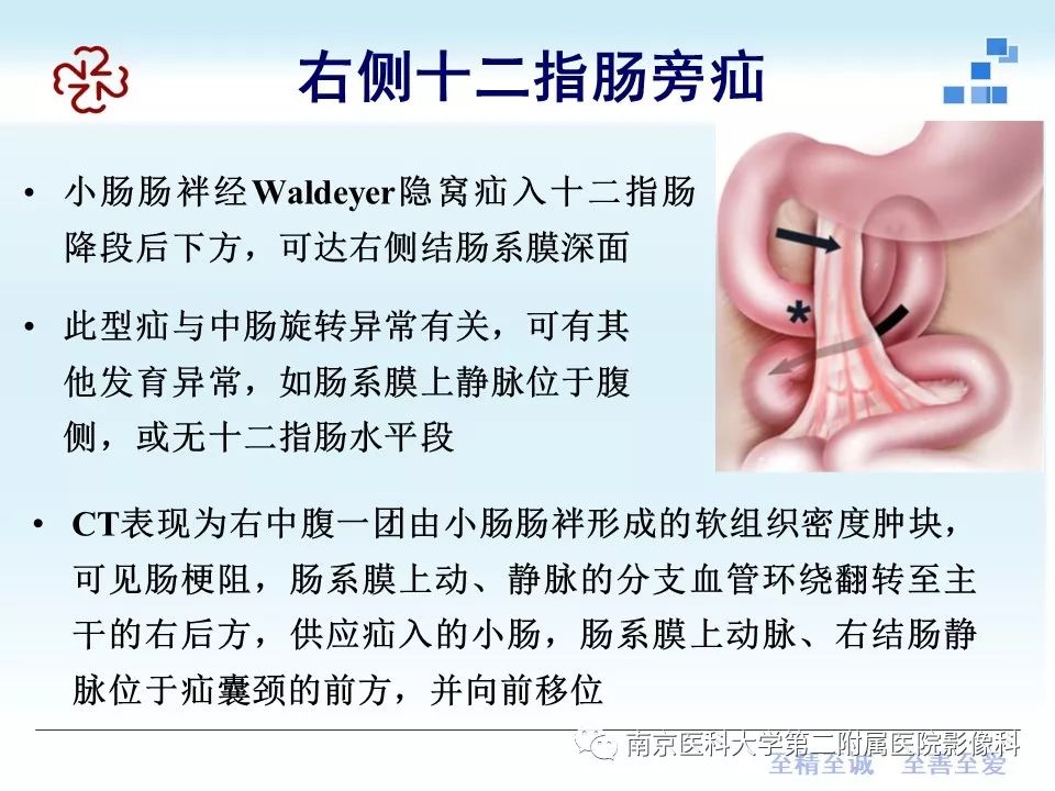 【PPT】腹内疝的CT表现