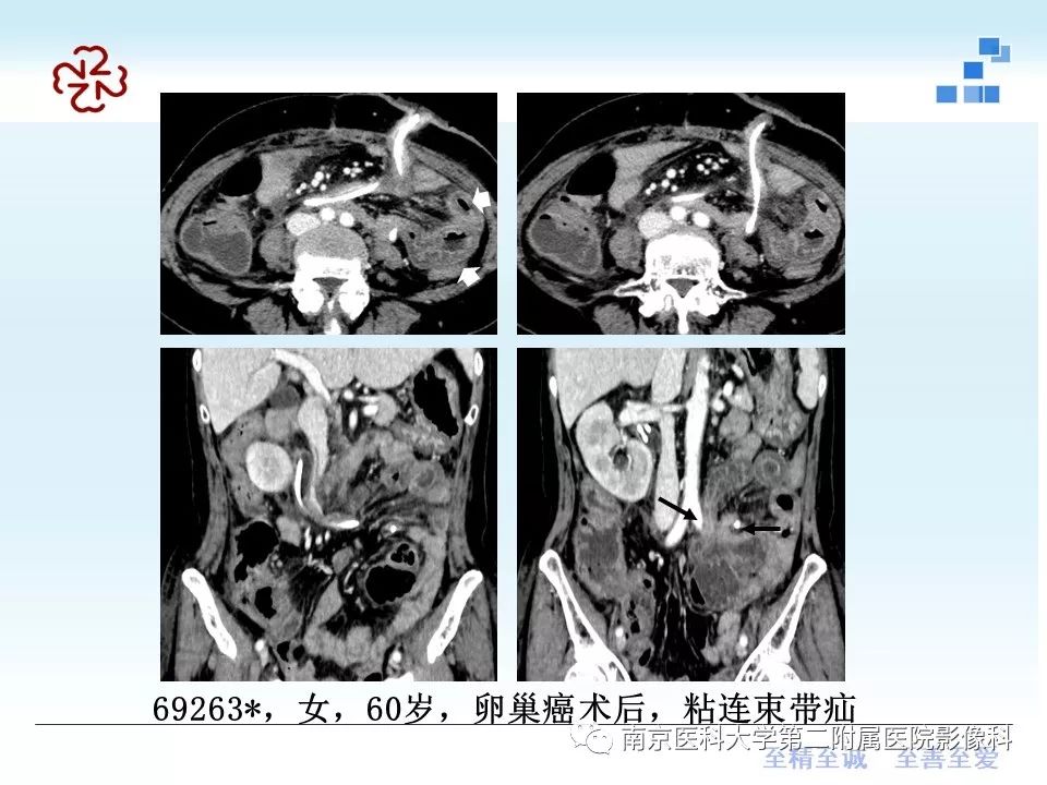 【PPT】腹内疝的CT表现