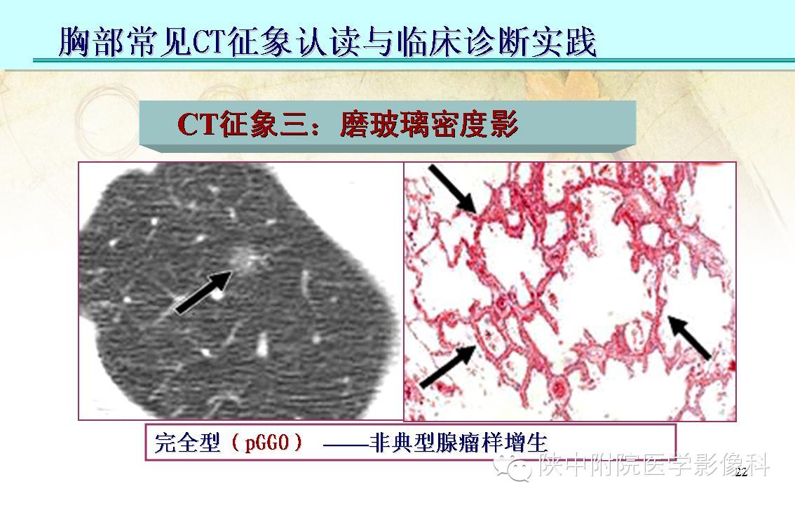 【PPT】胸部常见疾病的CT基本征象