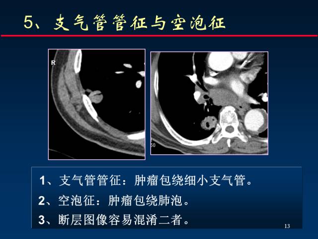 【PPT】肺癌CT征象的再探讨