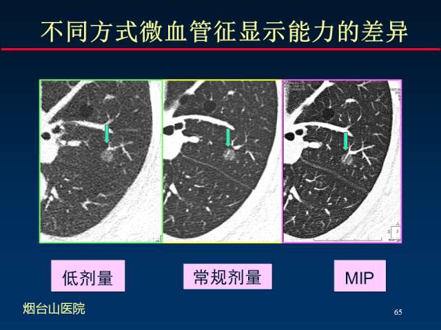 【PPT】肺癌CT征象的再探讨