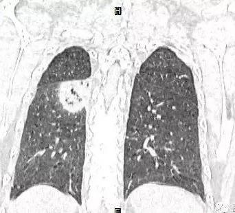 【病例】肺结核性空洞1例CT影像讨论分析