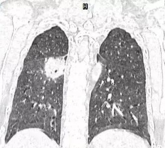【病例】肺结核性空洞1例CT影像讨论分析