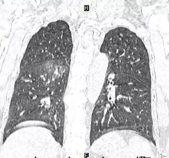 【病例】肺结核性空洞1例CT影像讨论分析