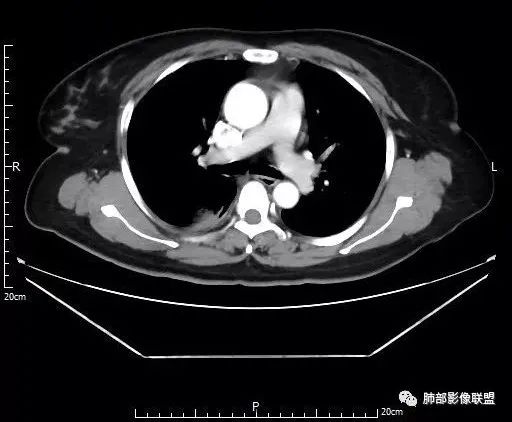【病例】肺结核性空洞1例CT影像讨论分析