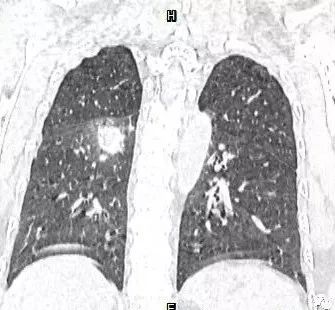 【病例】肺结核性空洞1例CT影像讨论分析