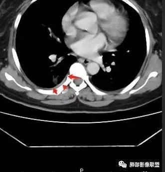 【病例】肺结核性空洞1例CT影像讨论分析