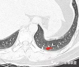 【病例】肺结核性空洞1例CT影像讨论分析