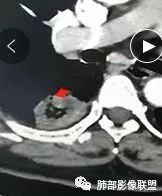 【病例】肺结核性空洞1例CT影像讨论分析 【病例】肺结核性空洞1例CT影像讨论分析