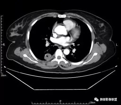 【病例】肺结核性空洞1例CT影像讨论分析