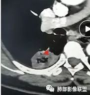 【病例】肺结核性空洞1例CT影像讨论分析 【病例】肺结核性空洞1例CT影像讨论分析