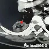 【病例】肺结核性空洞1例CT影像讨论分析 【病例】肺结核性空洞1例CT影像讨论分析