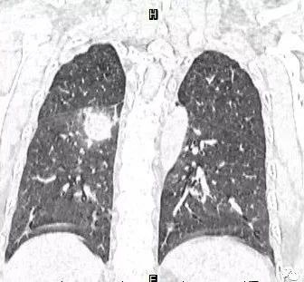 【病例】肺结核性空洞1例CT影像讨论分析