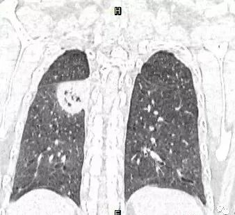 【病例】肺结核性空洞1例CT影像讨论分析
