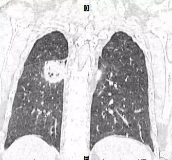 【病例】肺结核性空洞1例CT影像讨论分析