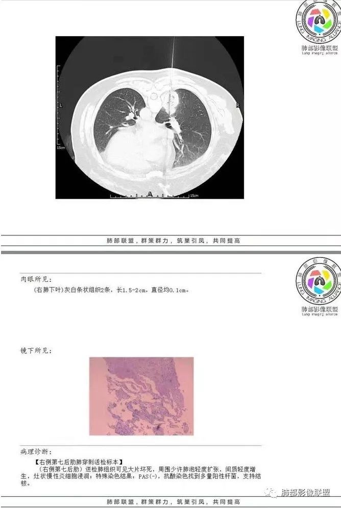 【病例】肺结核性空洞1例CT影像讨论分析