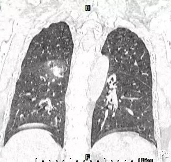 【病例】肺结核性空洞1例CT影像讨论分析