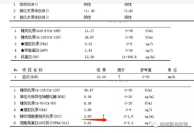 【病例】肺结核性空洞1例CT影像讨论分析 【病例】肺结核性空洞1例CT影像讨论分析
