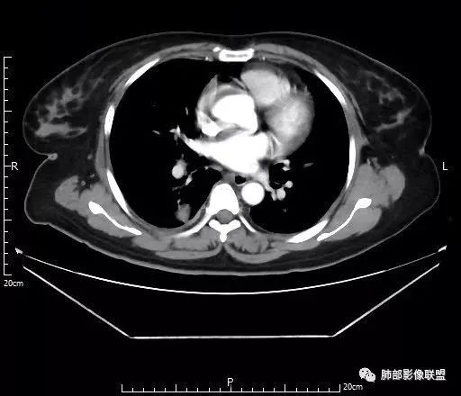 【病例】肺结核性空洞1例CT影像讨论分析