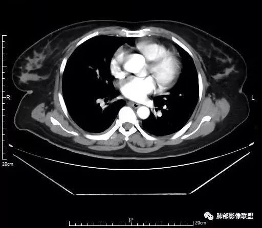 【病例】肺结核性空洞1例CT影像讨论分析