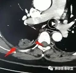 【病例】肺结核性空洞1例CT影像讨论分析 【病例】肺结核性空洞1例CT影像讨论分析