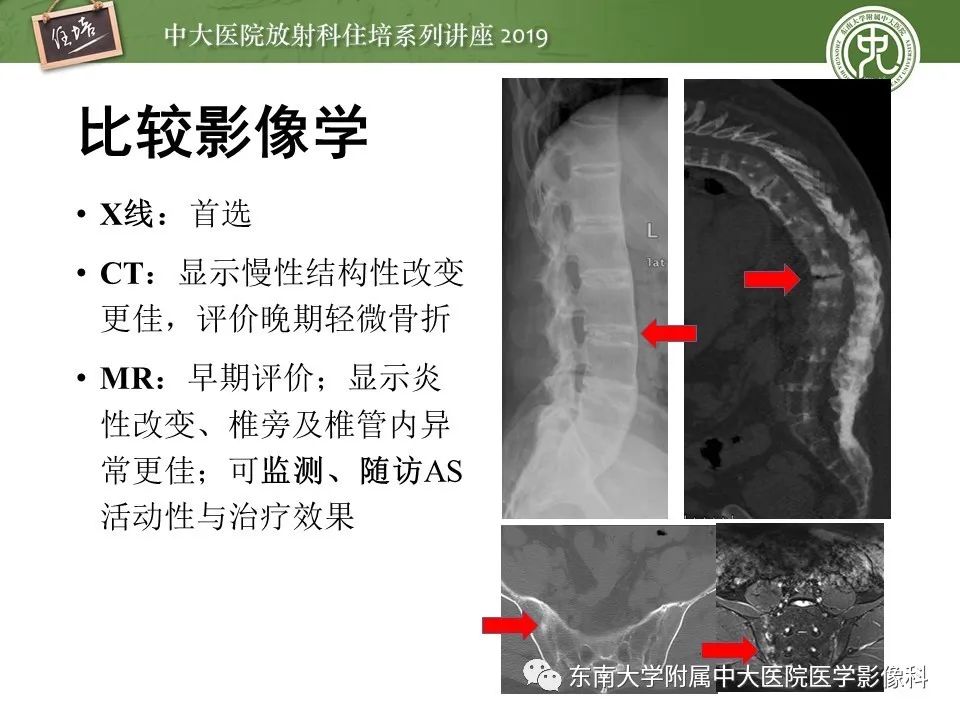 【PPT】强直性脊柱炎影像学评估