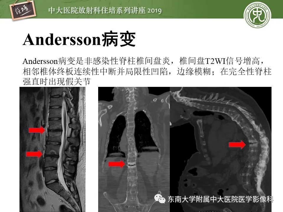 【PPT】强直性脊柱炎影像学评估