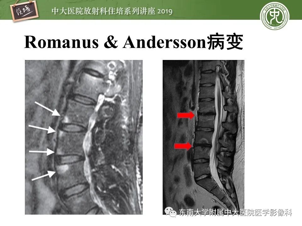 【PPT】强直性脊柱炎影像学评估