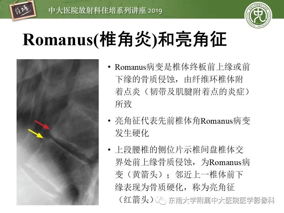 【PPT】强直性脊柱炎影像学评估