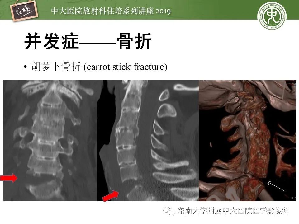 【PPT】强直性脊柱炎影像学评估