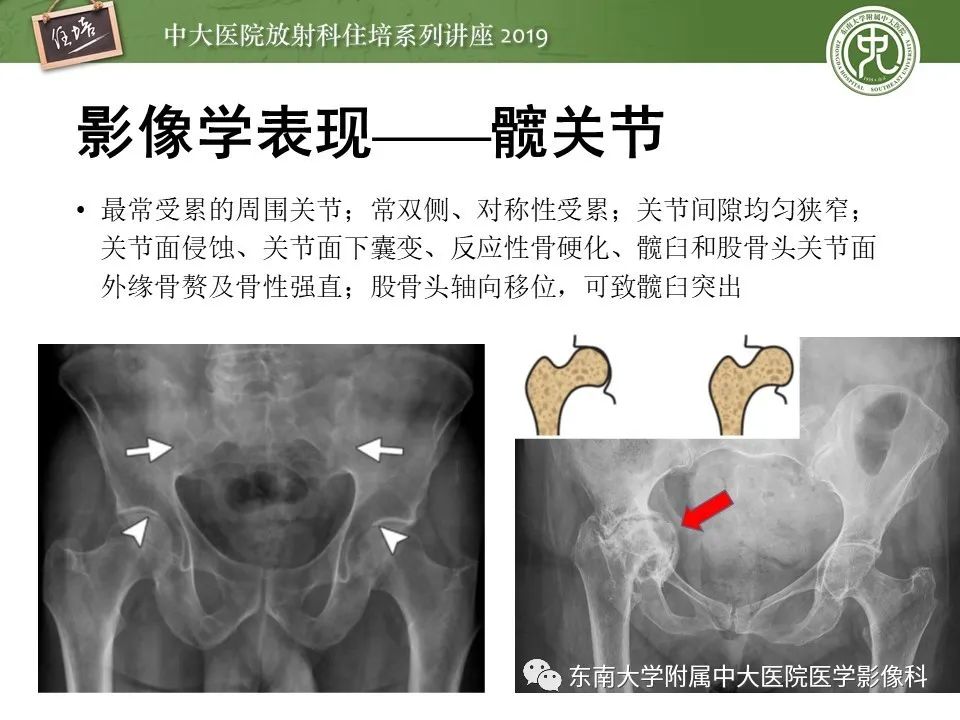 【PPT】强直性脊柱炎影像学评估