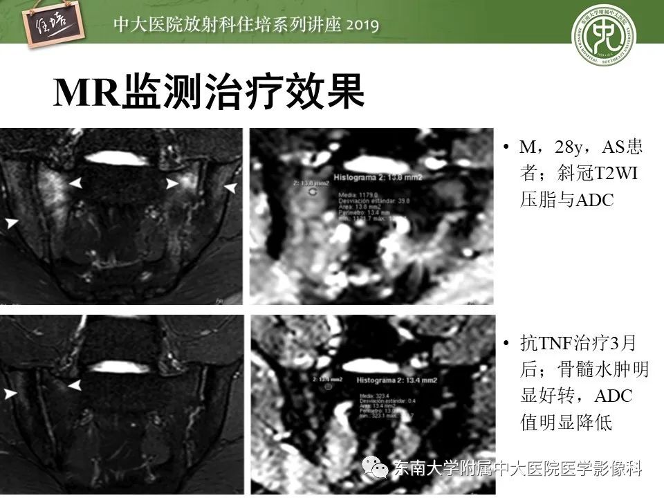 【PPT】强直性脊柱炎影像学评估
