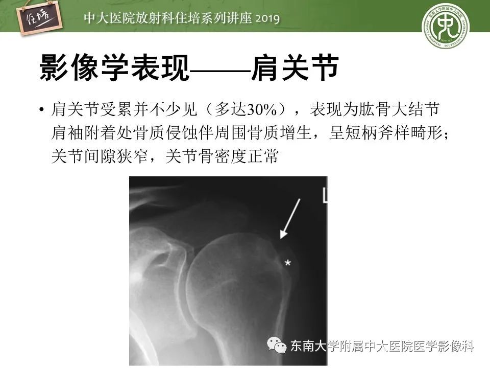 【PPT】强直性脊柱炎影像学评估