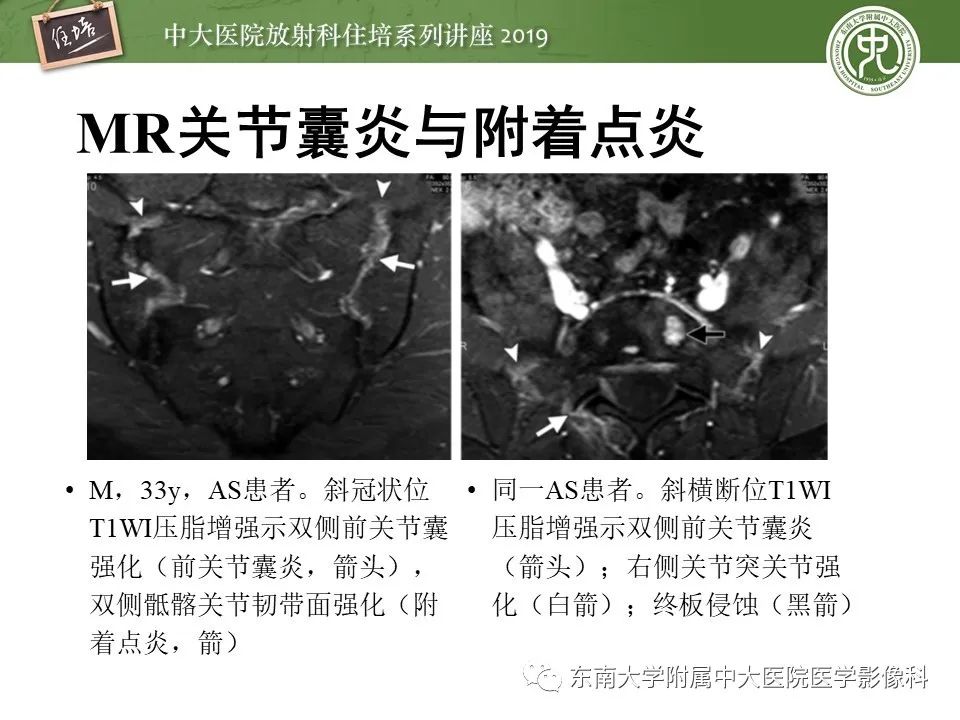 【PPT】强直性脊柱炎影像学评估