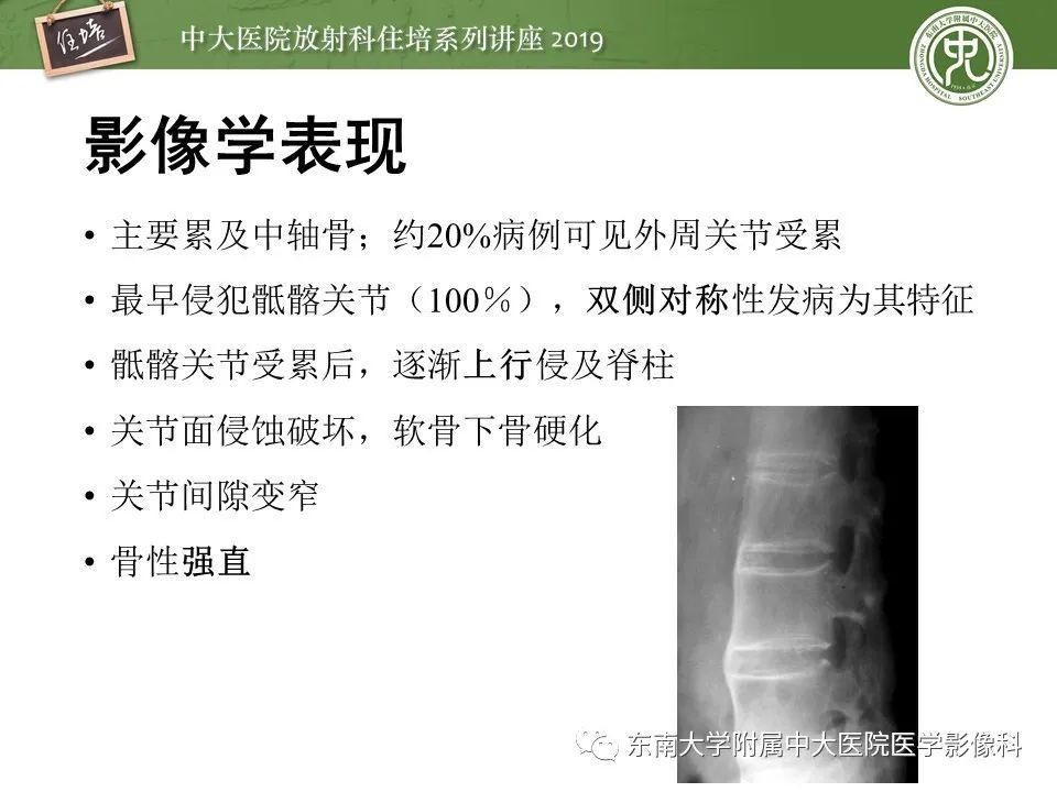 【PPT】强直性脊柱炎影像学评估