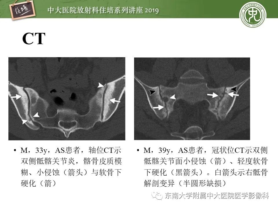 【PPT】强直性脊柱炎影像学评估