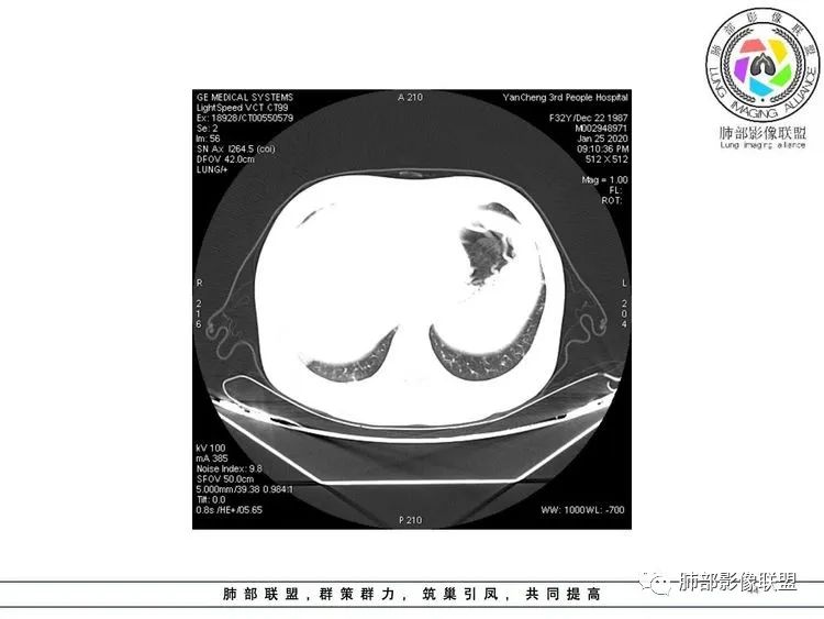 【病例】武汉归来，发热伴肺部阴影—水痘病毒性肺炎1例CT影像讨论