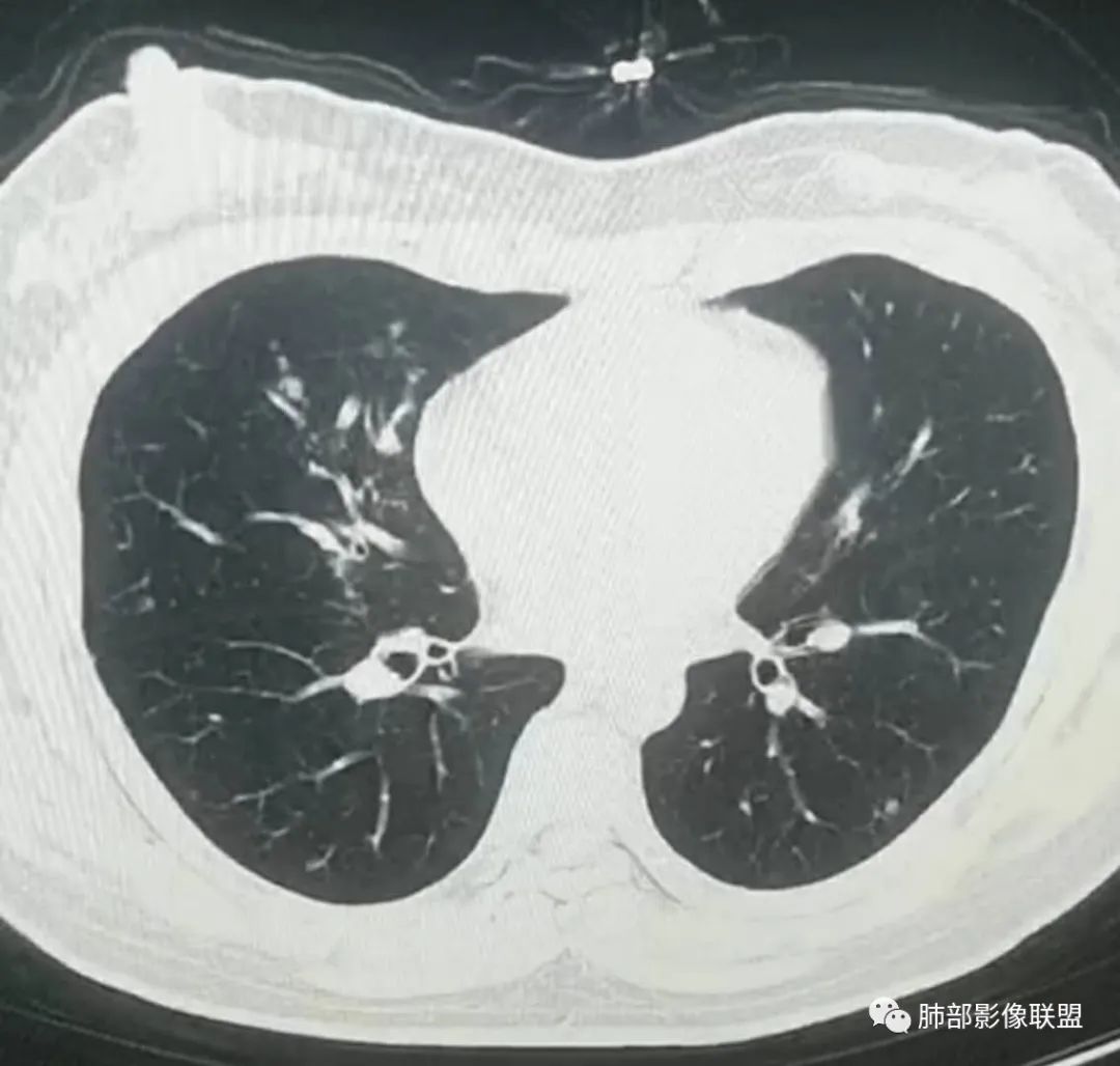 【病例】武汉归来，发热伴肺部阴影—水痘病毒性肺炎1例CT影像讨论