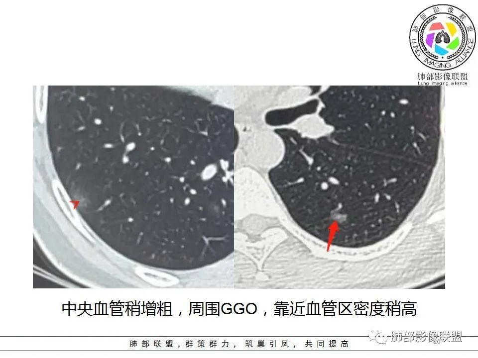 【PPT】如何快速掌握新冠肺炎（NCP）的影像识别？
