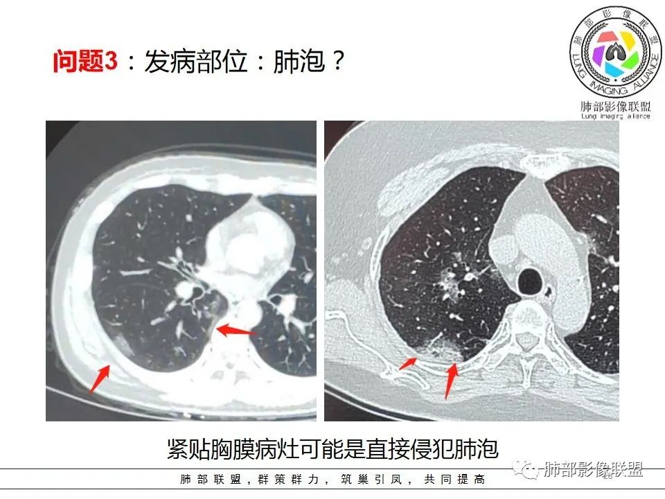 【PPT】如何快速掌握新冠肺炎（NCP）的影像识别？