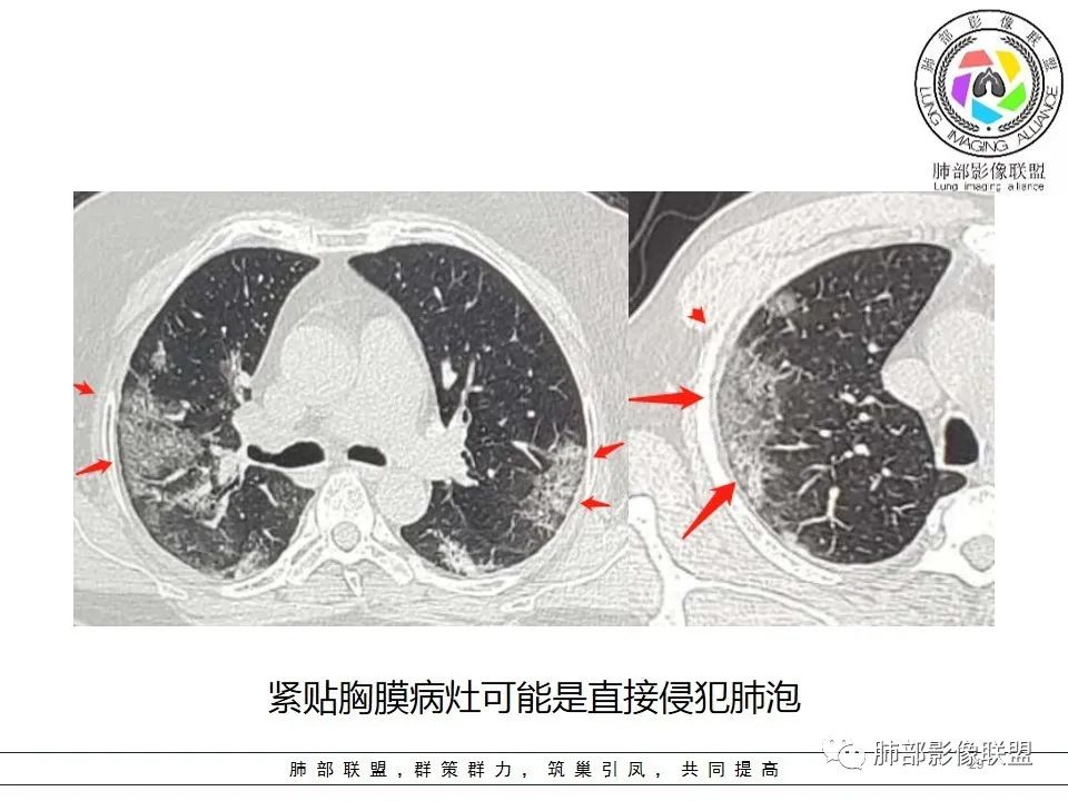 【PPT】如何快速掌握新冠肺炎（NCP）的影像识别？